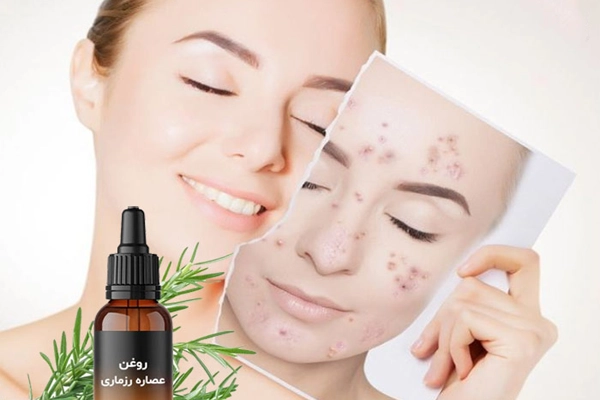 خواص روغن رزماری برای لک صورت